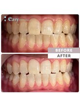 イージーホワイトニング 中野店(easy whitening)/セルフホワイトニング症例写真