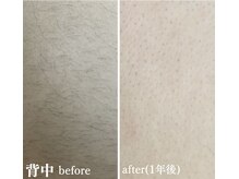 エステティック レイビス 八戸店(RAYVIS)/脱毛ならRAYVISヘ！