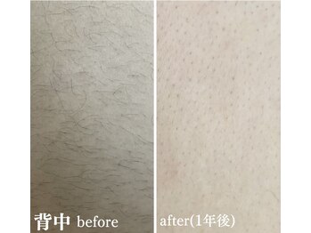 エステティック レイビス 八戸店(RAYVIS)/脱毛ならRAYVISヘ！