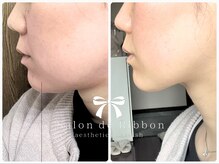 サロン ド リボン(Salon de Ribbon)の雰囲気（【輪郭形成】結果重視こだわりのメニュー構成『レッドショット』）