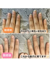 桃の木 吉祥寺店/痛んだ爪は元には戻りません