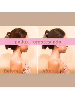 ポルクス鍼灸整骨院 表参道(Pollux鍼灸整骨院)/鍼灸整体 ビフォーアフター