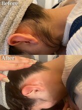 ラナ(Lana)/うなじW脱毛