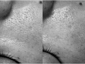 フェリス(FELIZ)/プラズマフェイシャル