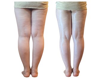 ベンザイ 梅田店(BENZAI)/セルライト、サイズダウン