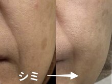 ジューンブライド(June Bride 61)/レーザーで取れなかったシミ改善