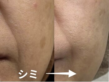 ジューンブライド(June Bride 61)/レーザーで取れなかったシミ改善