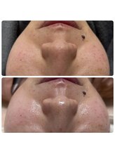 バイオ スキン プラス(Bio Skin Plus)/水光肌ピーリングで美白に！