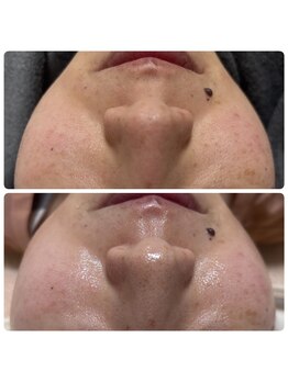 バイオ スキン プラス(Bio Skin Plus)/水光肌ピーリングで美白に!