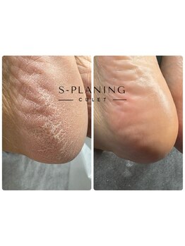 フットケアを受けたい