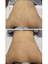 エラン(ELAN)/【Dr,s背中ハーブピーリング】