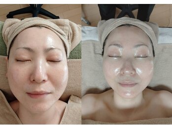 心音の写真/たるみの根本原因を改善と同時にハリ、ふっくらしたハリ、ツヤ、透明感のあるお肌へ。