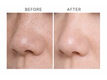 ザ ギフト 栄(The Gift)/根本改善！毛穴レスで水光肌に♪