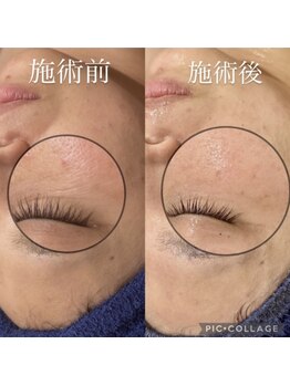 シャルム(CHARME)/目元の小じわを改善!