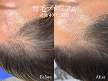 エイトスキン(8skin)/育毛促進ケア（エクソソーム）