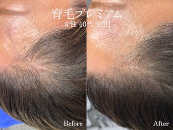 エイトスキン(8skin)/育毛促進ケア（エクソソーム）