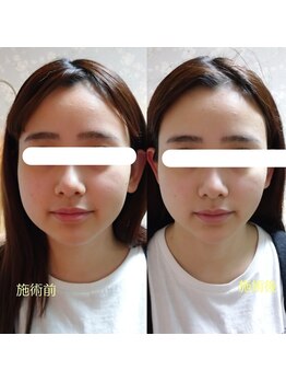 ドーズオフ(doze_off)/ドライヘッドスパ＋アイスパ