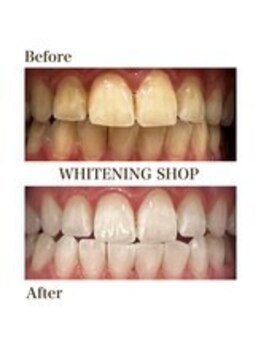 ホワイトニングショップ 新宿店/【ホワイトニング】BeforeAfter