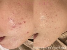 サロンヴェアリー 広尾(salon vary)/#ニキビケア#敏感肌