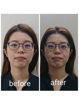 ベラージュ/小顔リフト・フレームアップケア