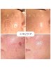 【気になるNO.2】ニキビケア*最新のプラズマケアでトラブル知らずな肌へ*