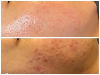 ヨリ(yori)/3ヶ月で変わった！