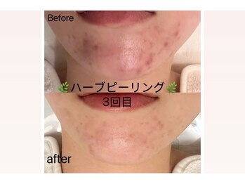 ユミ 町田鶴川店/OHLハーブピーリング