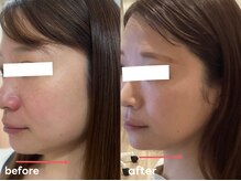 レアビューティー(Le'a beauty)/たるみ改善メニュー