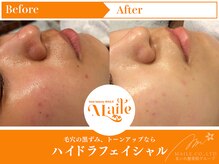 まいれ鍼灸院整骨院 整体院 草津院/ハイドラ／20代女性／施術8回