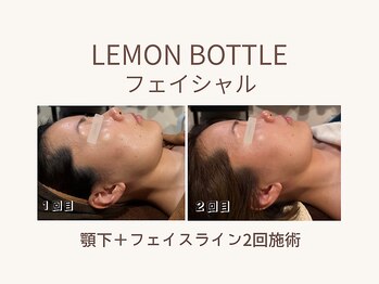 ビーモア(B.MORE)/2回でも変わる｜小顔印象