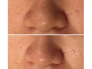 トリプルサンショップ 京都店/【アルファ毛穴コース】