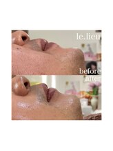 リュウ(le.lieu)/メンズフェイシャルの１回の変化