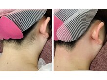 ルル(RuRu)/ Wax脱毛