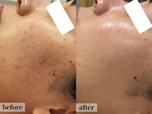 エステサロン ジョアアンジェ(joie ange)/ローズドメーラ　3回