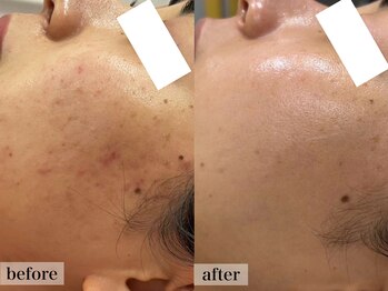 エステサロン ジョアアンジェ(joie ange)/ローズドメーラ 3回