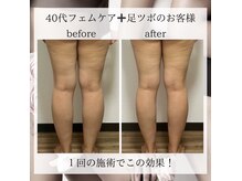 エフェ(Effet)の雰囲気（施術1回での変化です。デリケートなお悩みもご相談ください。）