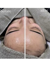 ホワイトアクア 明石店(WHITE AQUA)/小顔筋膜リリース