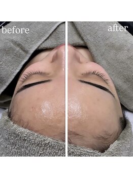 ホワイトアクア 明石店(WHITE AQUA)/小顔筋膜リリース