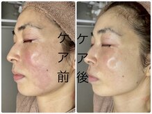 アンドエピ(&epi)/【赤ら顔改善】