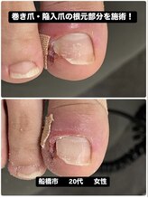 巻き爪じゅん 千葉駅前店/巻き爪陥入爪の痛みを施術で改善