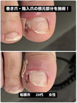 巻き爪陥入爪の痛みを施術で改善