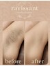 【女性限定】『ムレ＋臭い解消』美肌パーツ脱毛☆VIO＋脇　50%OFF→5,500円