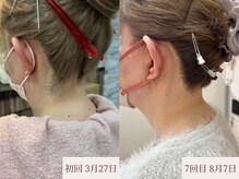 クラームビューティー(Clerm beauty)/美容師によるうなじデザイン脱毛