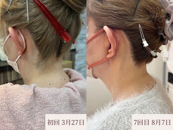 クラームビューティー(Clerm beauty)/美容師によるうなじデザイン脱毛