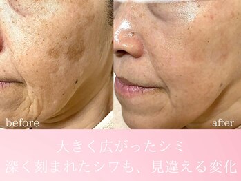 ファニービー 茨木店/60代 シミ 9ヶ月で改善