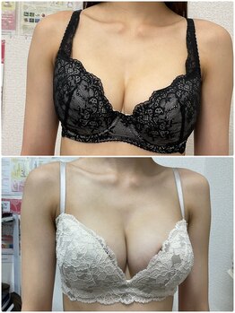 バーディー(BIRDIE)/施術１年/２０代/C→Fカップ