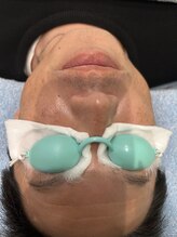 レイモード(Ray mode)/ヒゲ脱毛5回目