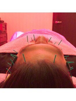 ポルクス鍼灸整骨院 表参道(Pollux鍼灸整骨院)/美容鍼灸