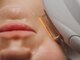 エモベーシック(e'MO BASIC)の写真/【ニキビ/毛穴ケア】BBL光フォト!ニキビ/開き毛穴専用ケア¥13,200→¥10,200!繰り返す大人ニキビはBBLで改善