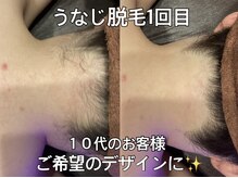 リエル(RIEL)/【うなじ脱毛】